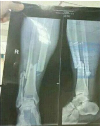 뎀바바엑스레이