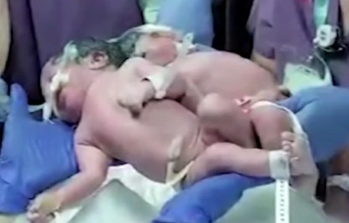 수술 전 샴쌍둥이 모습. 로이터. 재판매 및 DB 금지.