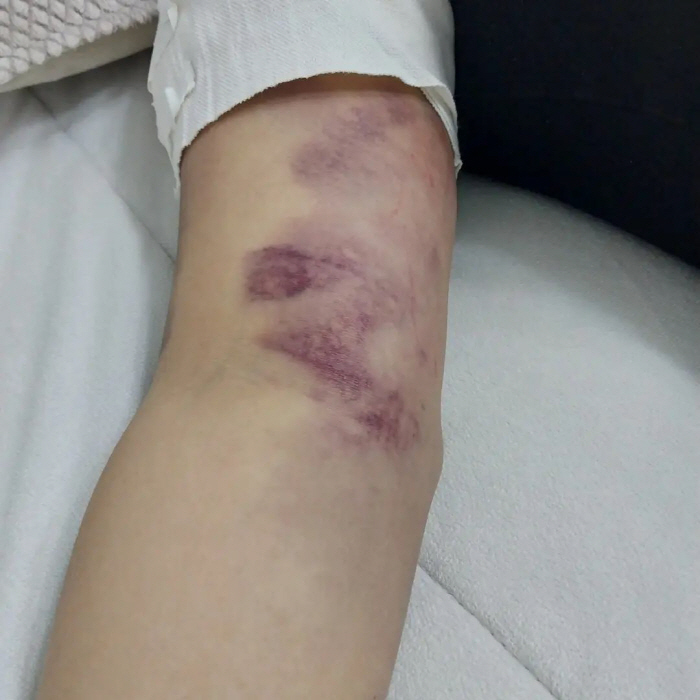 10기 정숙, 피멍으로 얼룩진 팔뚝…라방도 급취소 "약속 못지켜 죄송, …