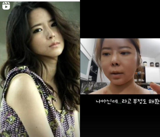 '이수근♥' 박지연, "'내 얼굴 아닌데'라 부정해"…스테로이드 부작용 …