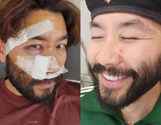 노홍철, '피범벅' 오토바이 사고 후 김태호PD와 재회…안경으로 흉터 가…