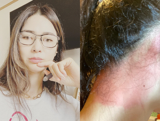 이소라, 심각한 피부 상태 "좋다고 난리 난 샴푸 따라 썼는데.."