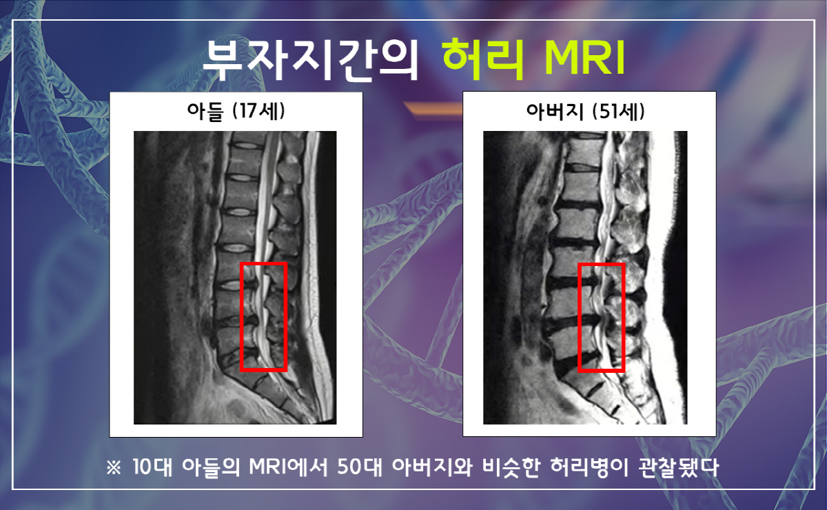허리디스크·척추관 협착증도 유전된다?