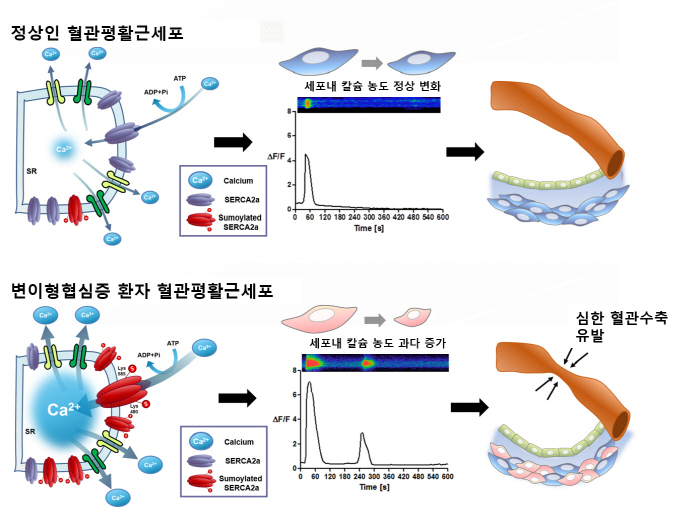 서울대병원 연구팀, 줄기세포 기술로 변이형 협심증 발생 기전 첫 규명