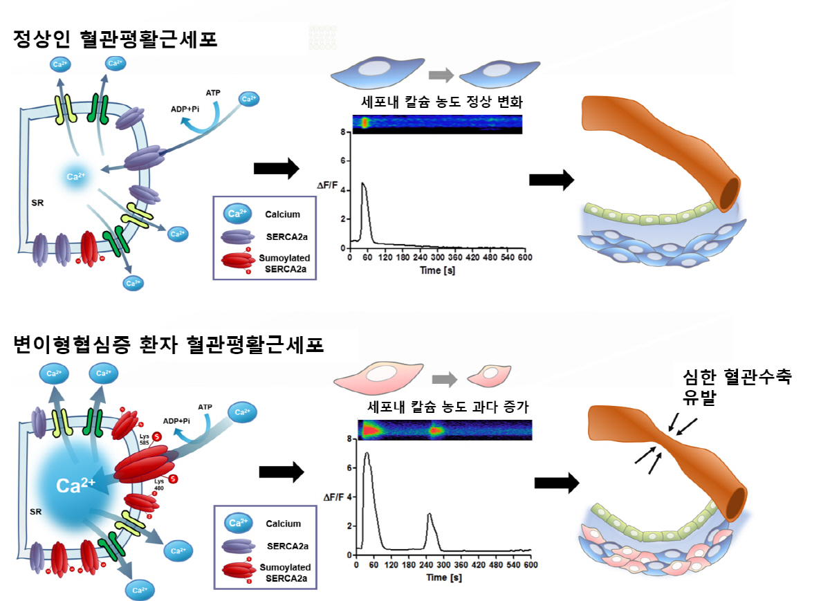 서울대병원 연구팀, 줄기세포 기술로 변이형 협심증 발생 기전 첫 규명