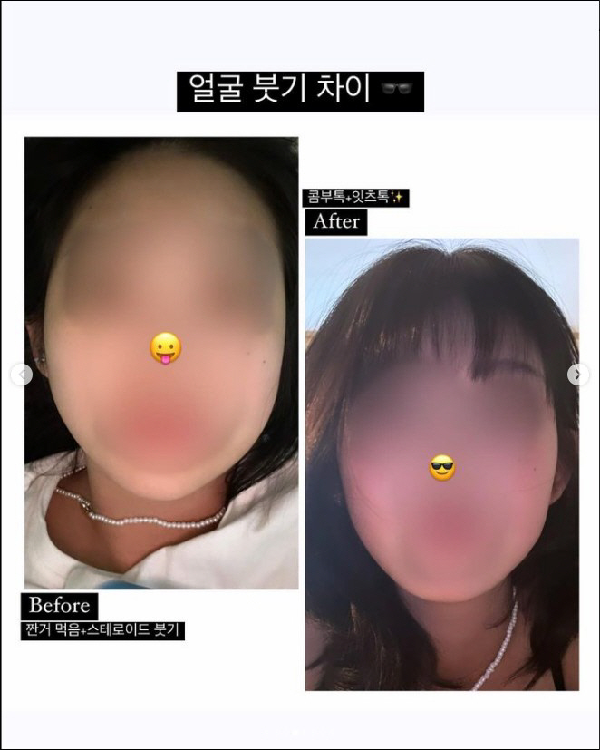 최준희, '눈코 재성형' 확 달라진 비포애프터 "성형부기 빠지는 속도 빨…