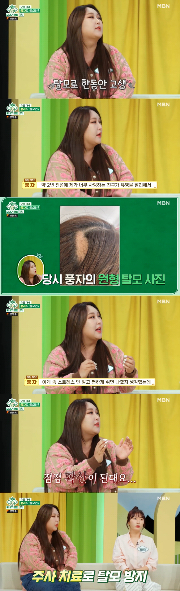 풍자, 심각한 원형탈모로 텅 빈 정수리..."두피에 주사 맞아" ('모내…