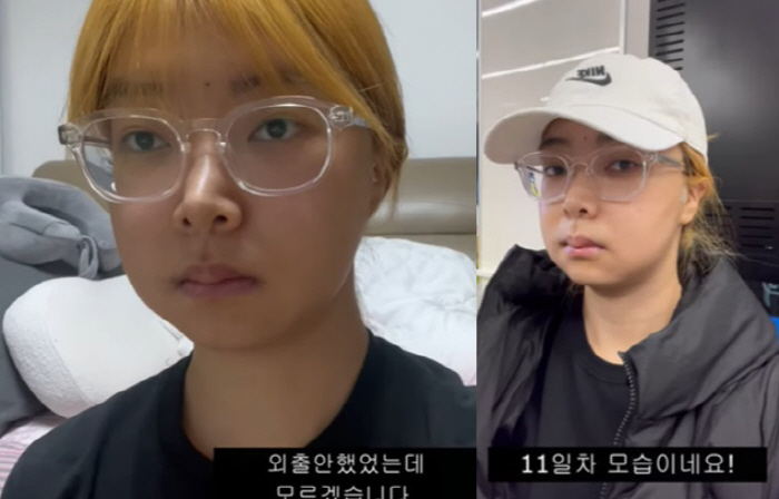 10기 영자, '양악 수술' 했지만 우울 "이래서 재혼 못하나"..달라진…