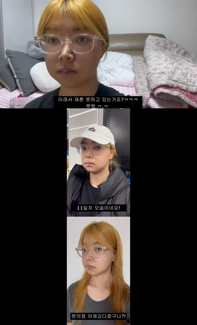 10기 영자, '양악 수술' 했지만 우울 "이래서 재혼 못하나"..달라진…