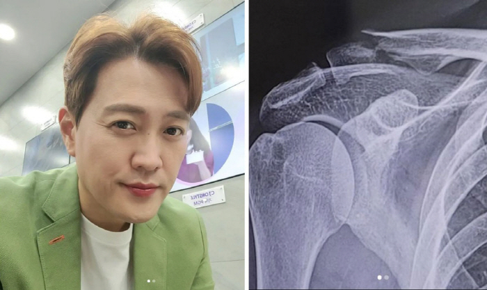 문천식, 빗길 자전거 사고로 '쇄골 박살'…"수술은 포기"