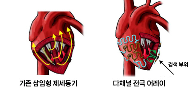 서울대병원·기초과학연구원 '다채널 전기 자극 어레이' 개발…삽입형 제세동…