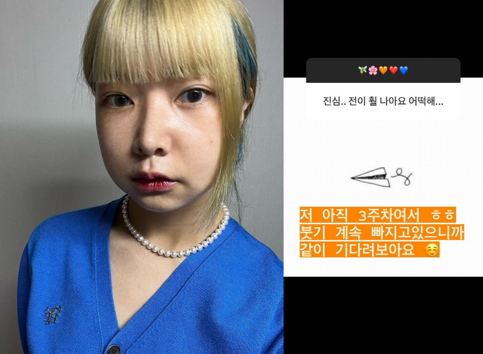 10기 영자 "양악수술 전이 훨씬 나아" 악플에 "부기 계속 빠지니 기다…