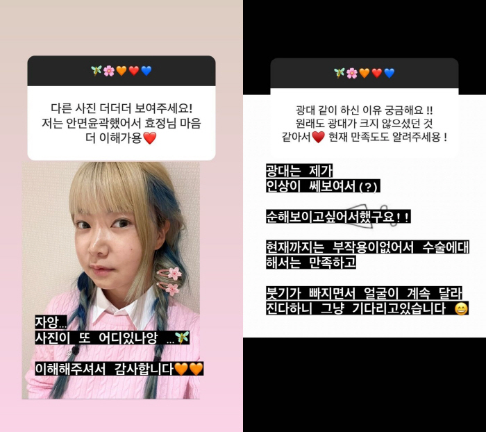 10기 영자 "양악수술 전이 훨씬 나아" 악플에 "부기 계속 빠지니 기다…