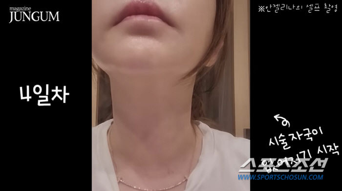 '62세' 박준금, 목에 빨간 자국이 여기저기 '충격'…목 시술과 잡티 …