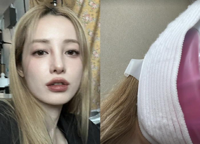 유깻잎, 성형수술 후 '생생한 회복기'…퉁퉁 부은 얼굴에 "뜨끈하게 지지…
