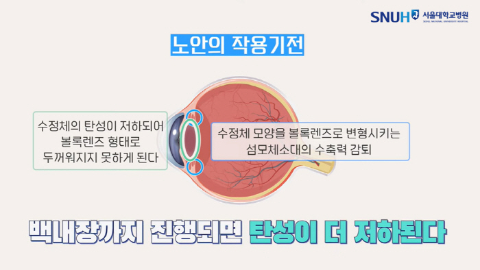 [노안 Q&A] 시력 교정 안해도 악화 안돼…'산화 스트레스' 막아야