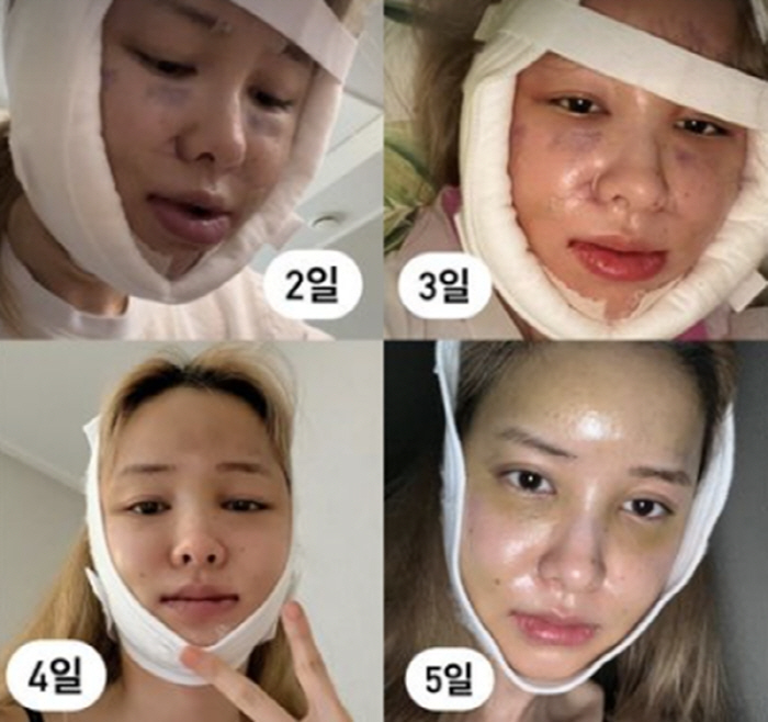 유깻잎, '얼굴에 가득한 피멍+퉁퉁 부은 눈코입'…생각보다 심각했던 회복…