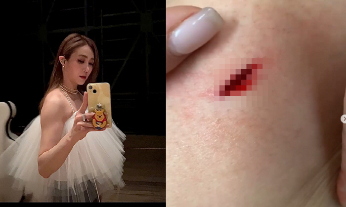 "지금은 괜찮아요"…옥주현, 허벅지 상처 공개 "피가 줄줄 흘렀을 정도"
