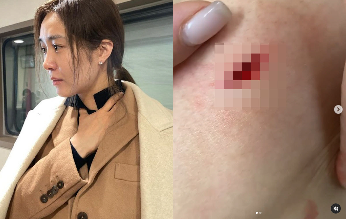 옥주현, '피 철철' 흘린 허벅지 상처 공개..."피가 폭포처럼 흘러"