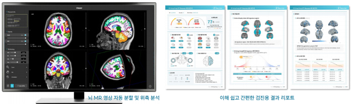 길병원 VIP건강증진센터, 뇌MRI와 인공지능 활용 알츠하이머·파킨슨 조…