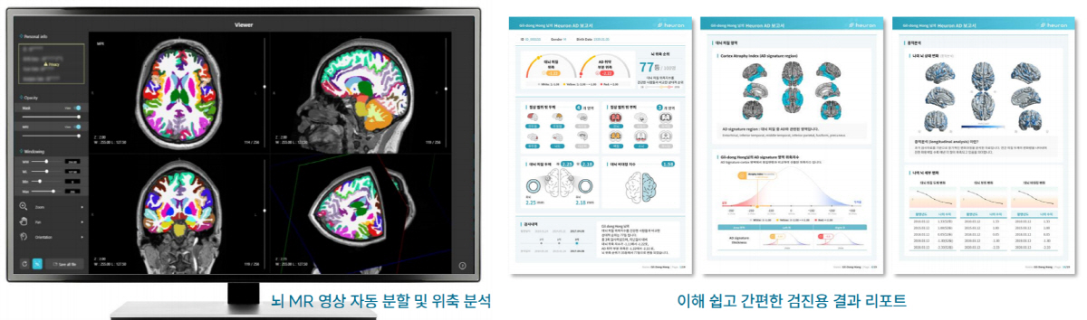 길병원 VIP건강증진센터, 뇌MRI와 인공지능 활용 알츠하이머·파킨슨 조…