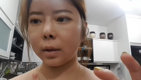 '이수근♥' 박지연, 스테로이드 부작용 전후 "부기 빠지며 얼굴 무너져,…