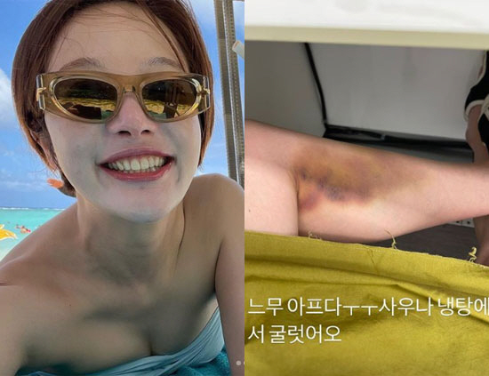 황보라, '피멍 든 팔' 촬영 아니라 실제상황 "사우나서 굴렀어요"
