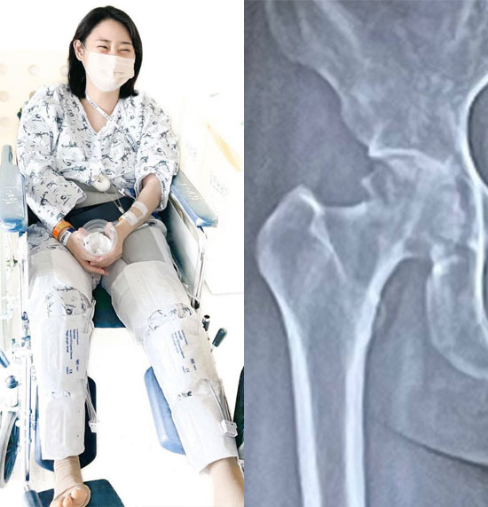 '간 이식' 받았던 윤주, 이번엔 고관절 수술 "하고싶은거 다하고 싶어"