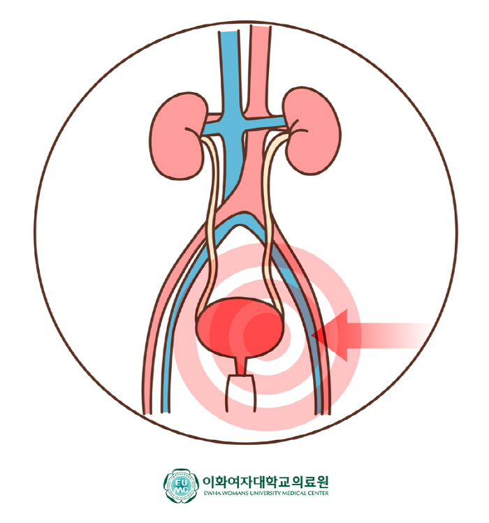 아랫배 묵직, 뻐근한 증상 알고보니 '간질성 방광염'