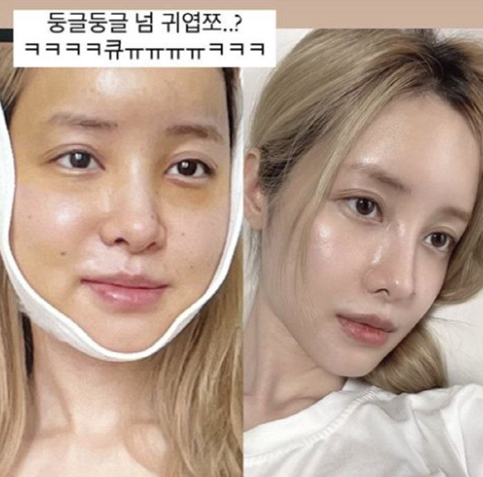 '최고기와 이혼' 유깻잎, 퉁퉁 부은 얼굴·가득한 멍자국 "둥글둥글 넘 …