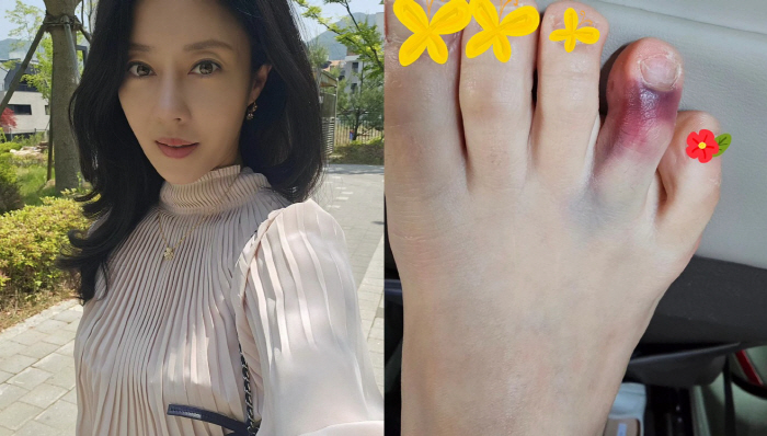 '싱글맘' 이지현, 새벽 출근 준비 중 발가락 부상 "제대로 걷지도 못해…