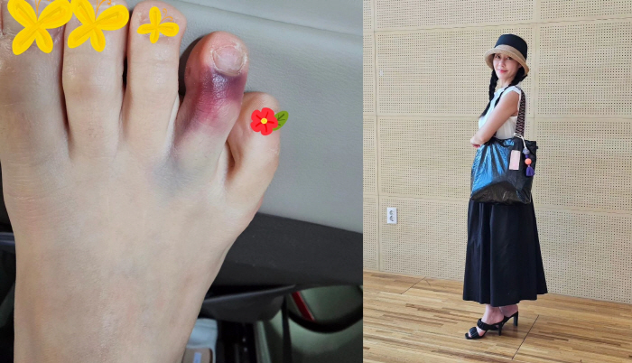 이지현, 발가락 부상에 "하루종일 제대로 걷지도 못하고, 너무 아파요"