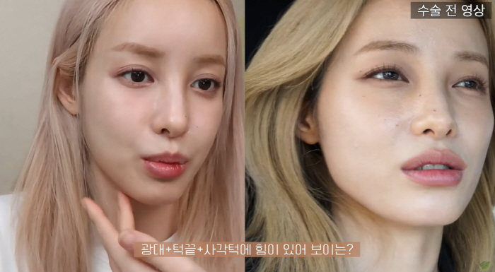 유깻잎, 윤곽 수술 후 달라진 광대+턱라인 "중성적인 느낌 확실히 덜해"