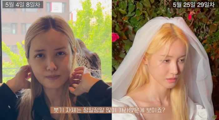 유깻잎, 윤곽 수술 후 달라진 광대+턱라인 "중성적인 느낌 확실히 덜해"
