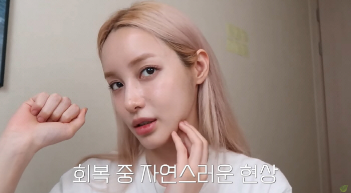 유깻잎, 윤곽 수술 후 달라진 광대+턱라인 "중성적인 느낌 확실히 덜해"