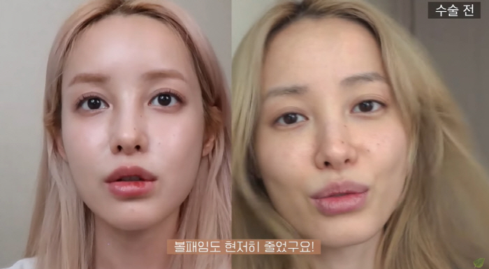 유깻잎, 윤곽 수술 후 달라진 광대+턱라인 "중성적인 느낌 확실히 덜해"