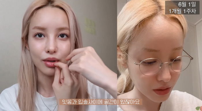 유깻잎, 윤곽 수술 후 달라진 광대+턱라인 "중성적인 느낌 확실히 덜해"