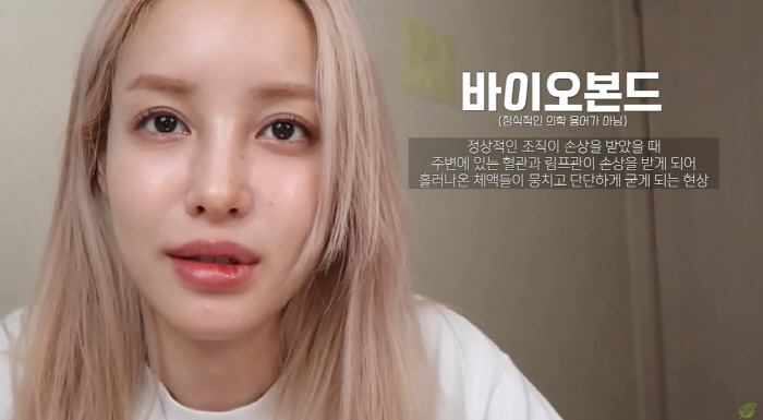 유깻잎, 윤곽 수술 후 달라진 광대+턱라인 "중성적인 느낌 확실히 덜해"