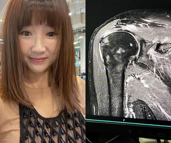'50대' 윤현숙 "선천적 어깨뼈 기형…뼈를 깎는 수술해야 돼"