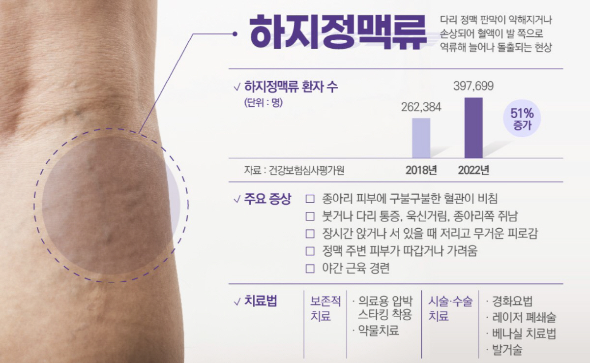 다리 혈관 울퉁불퉁 '하지정맥류', 치료는?…스타킹·스키니진 피해야