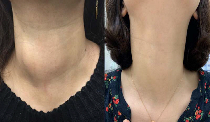 미용 문제 유발 갑상선 결절, 흉터 없는 '고주파 절제술' 장기 치료 효…