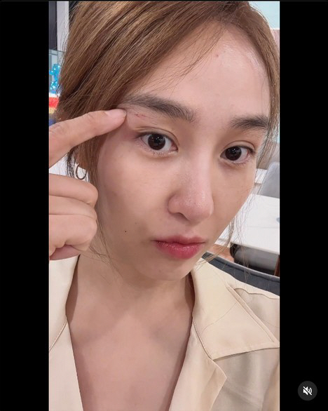 옥주현, 日 여행중 날벼락...눈 밑 선명한 '꿰맨 자국'