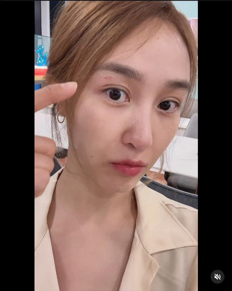 옥주현, 日 여행중 날벼락...눈 밑 선명한 '꿰맨 자국'