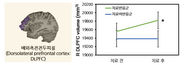 "항우울제 치료 반응 우울증 청소년, 신경 세포 회복 가능성 높아"