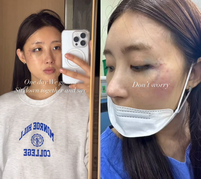 현아, 낙마사고 '충격'…얼굴에 온통 피멍 "상태가 처절했다"