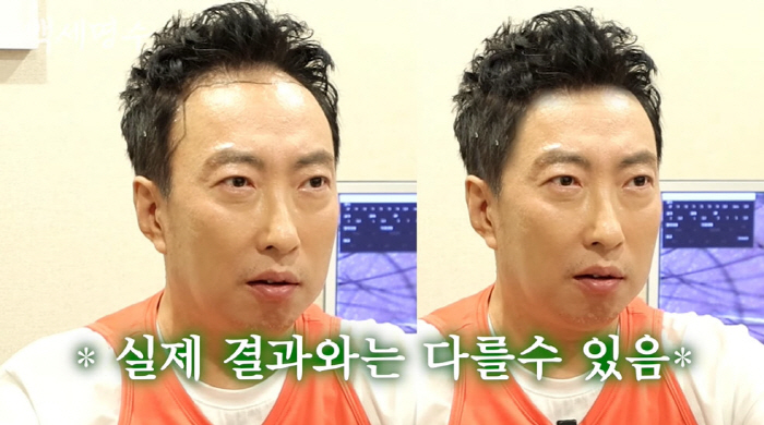 박명수, 3천모 모발 이식 수술 상담 "너무 날라갔다" ('백세명수')