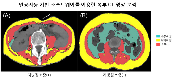 "지방감소증 동반된 루게릭병 환자, 사망 위험 최대 6배 높아"