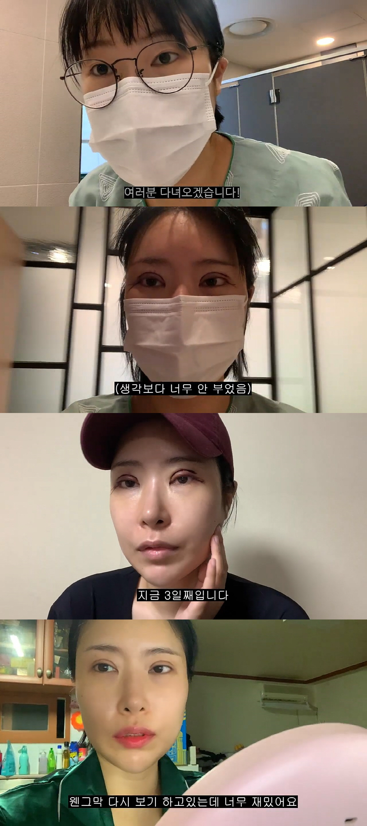 이세영, 쌍꺼풀 재수술 "몇번 했는데 떨려..코수술보다 더 아파"('영평…