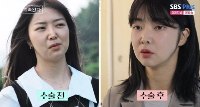 10기 영자, 양악수술 이유=악플 "얼굴 삐뚤어 마음 삐뚤고 이혼했다고"…