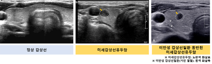 특정 초음파 소견 보이는 미세갑상선유두암, 종양 진행 가능성 높아